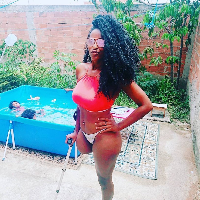 Natasha Vinogradova amputa