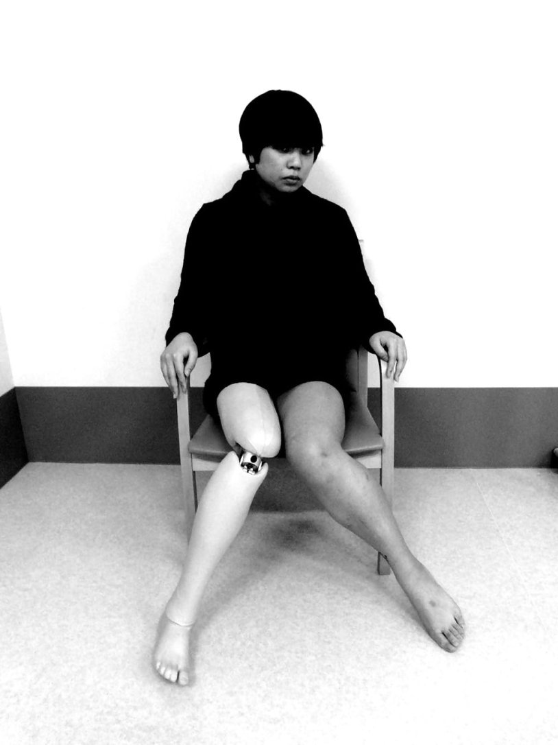 Elizaveta Tkachenko Amputee