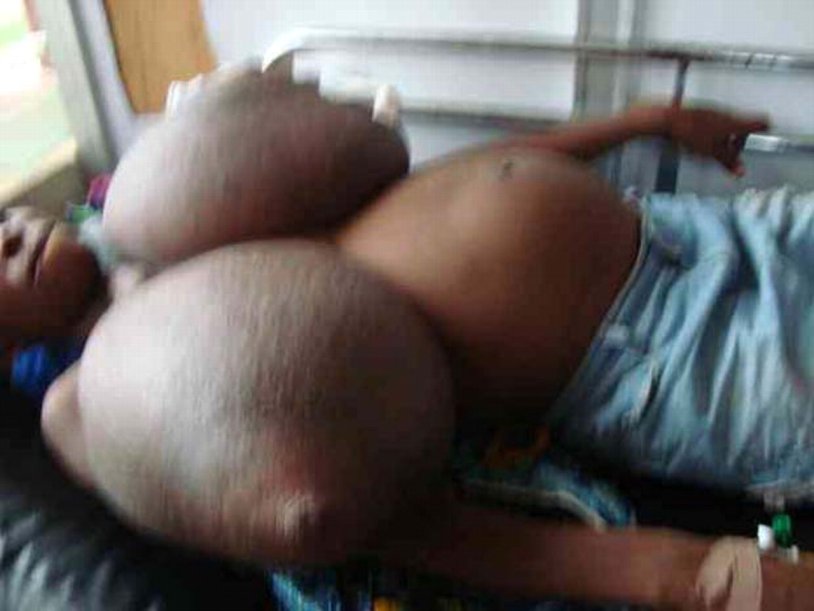 Giantomastia huge boobs