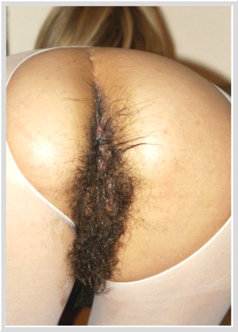 Hairy woman's ass