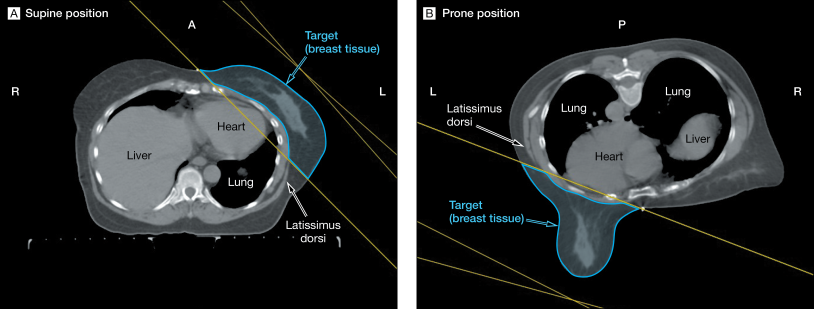 Prone Position Ventilation under Covid