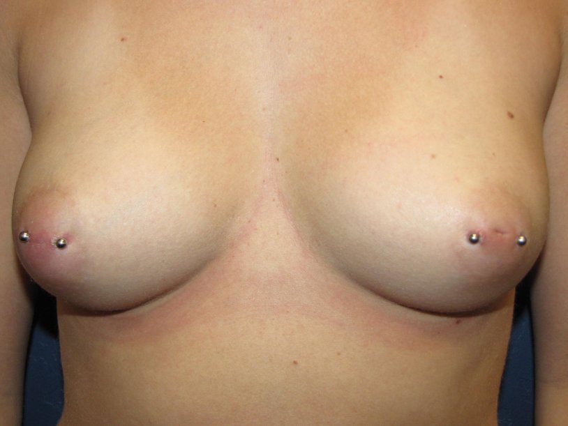 Unusual breast piercing