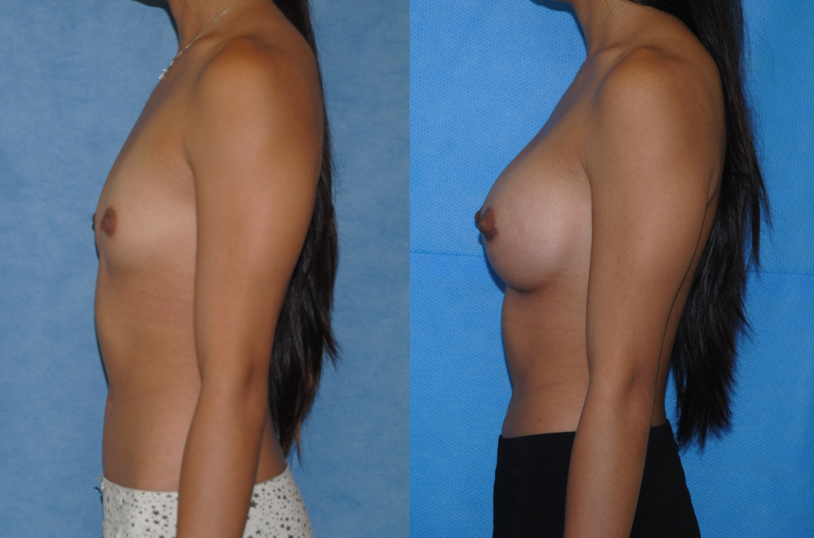 Casting with large breasts