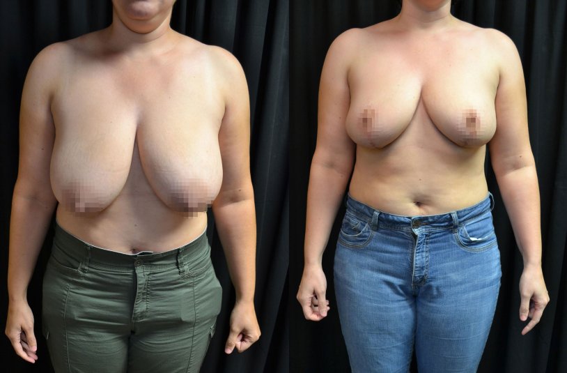 Women with macromastia naked