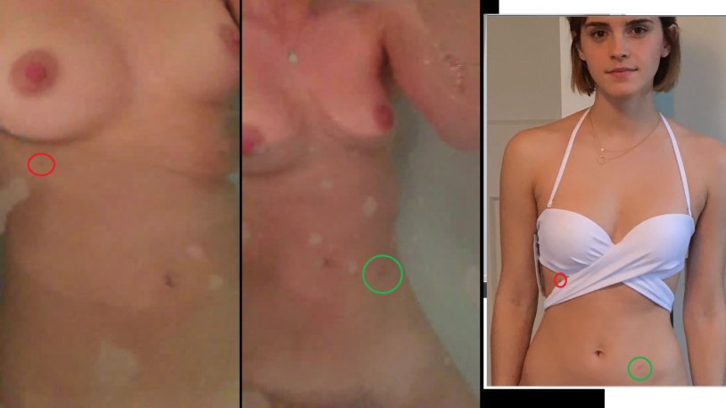 Emma Watson Naked after the chest surgery