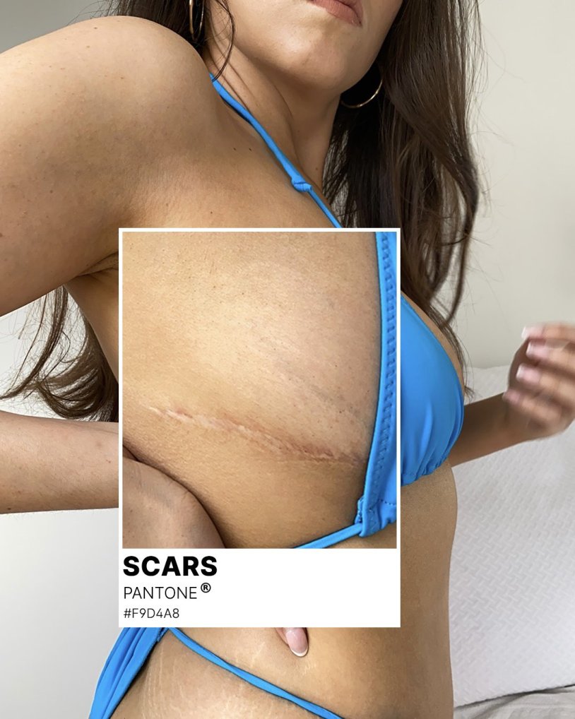 Scar after abdominoplasty