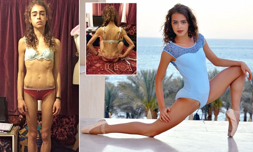 Leila Pekhlevi anorexia