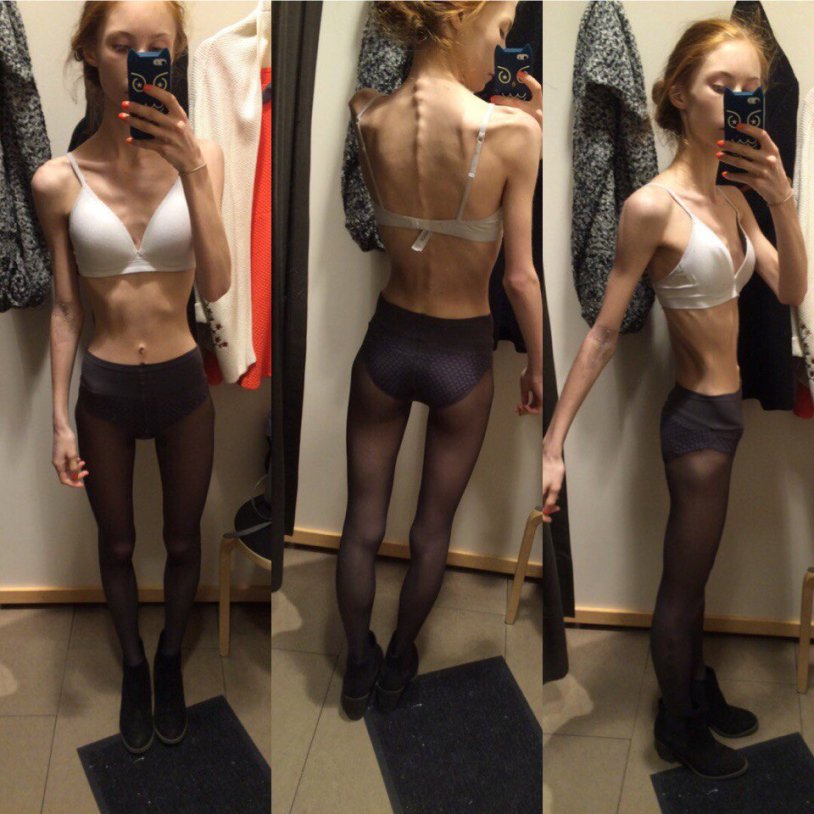 Anorexica in underwear