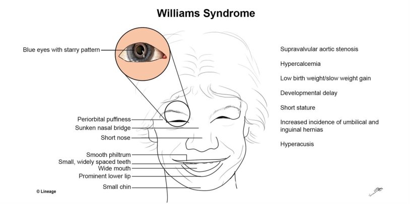 Elven facial features syndrome