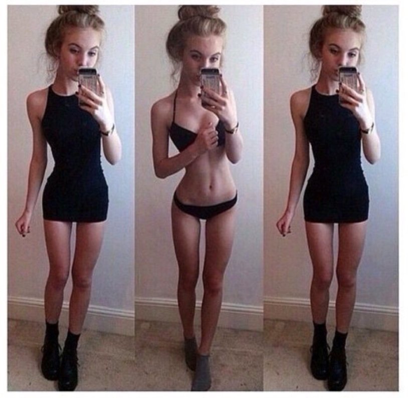 Maria Zholobova anorexia