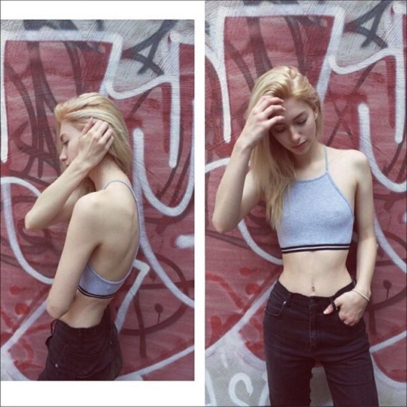 Sarah Marie Karda anorexia