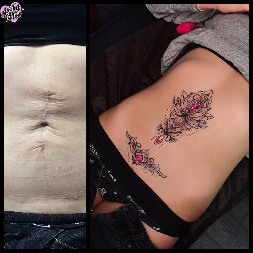 Tattoo ceiling cesarean scam