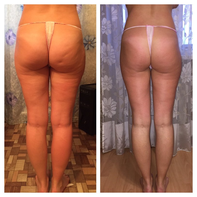 Honey massage before and after