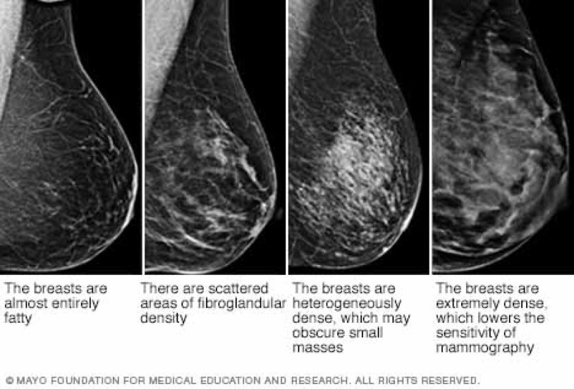 Breast formation