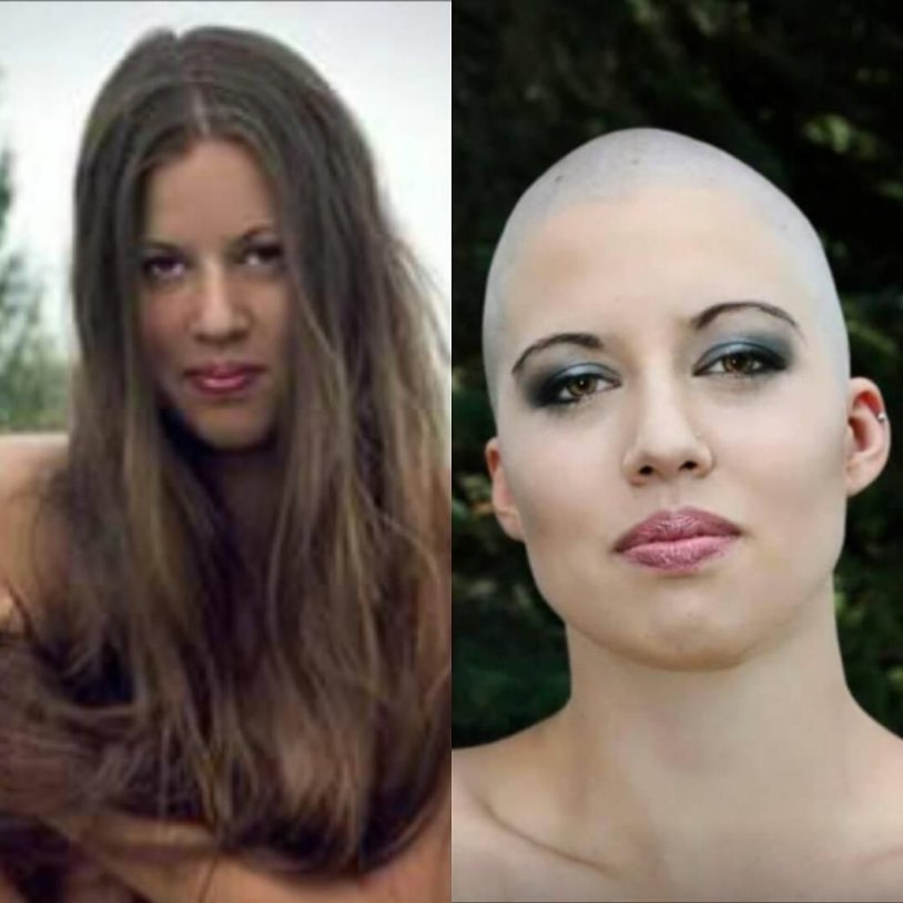 Bald Girl Before and After