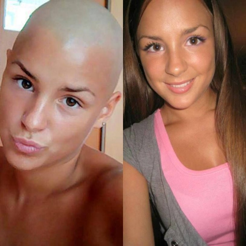 Bald girl before and after