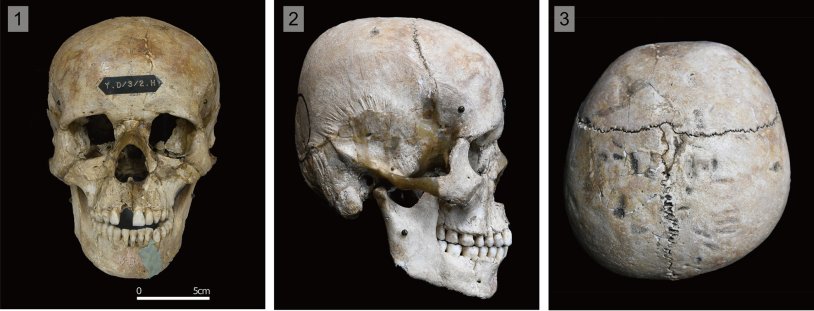 Deformation of the skull Huns