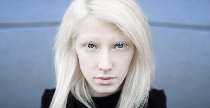 Girl Albino