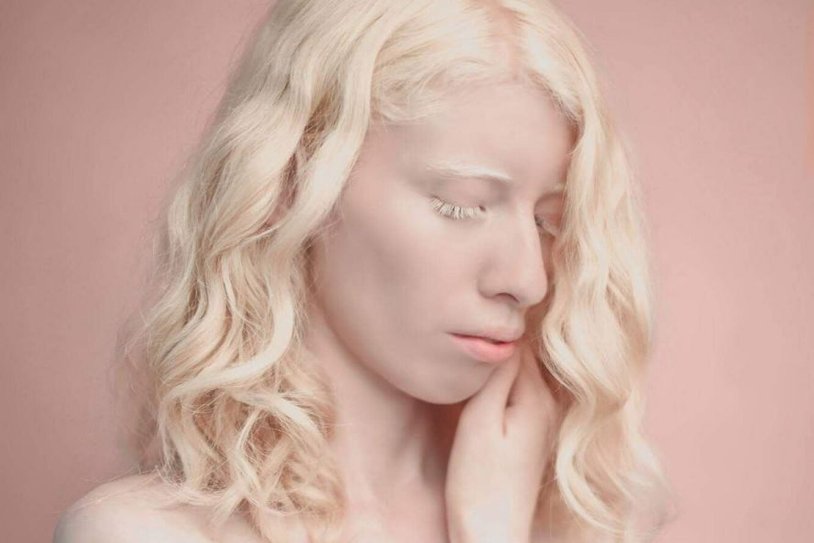 The appearance of albinos with curly hair