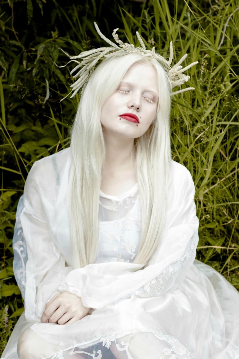 Rosie Crawford Albino