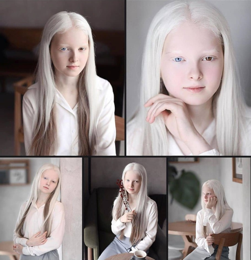 Amina Ependieva girl Albino