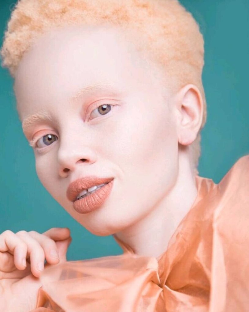 Negro Albino Girl
