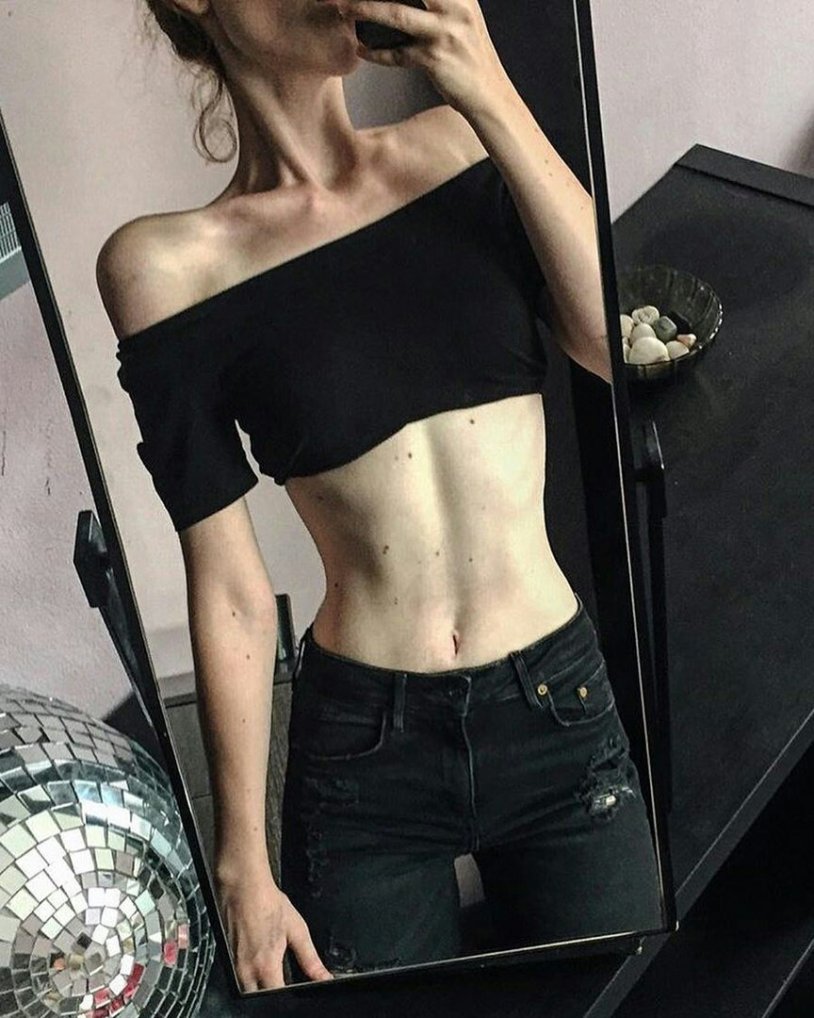 Daria Parkhomenko anorexia