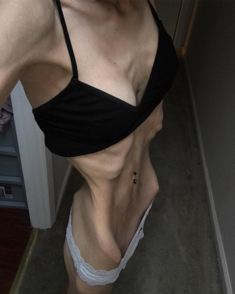 Brittani Robinson anorexia