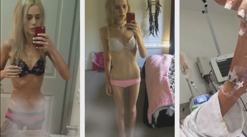 Khilkevich Anna Anorexia Anorexia