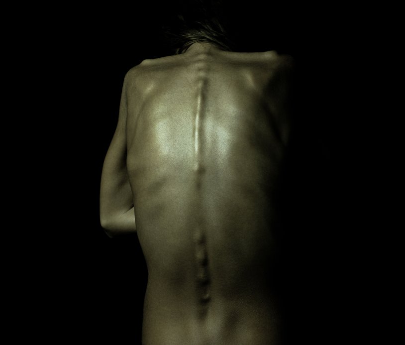 The spine of anorexics