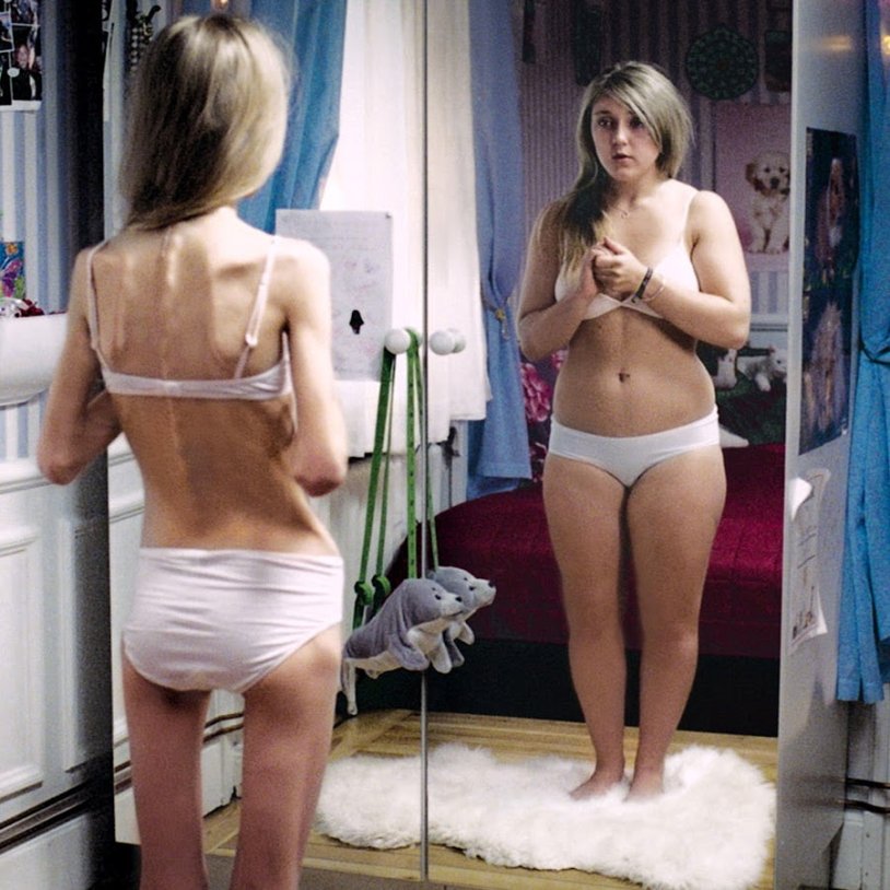 Anna Zholobova anorexia