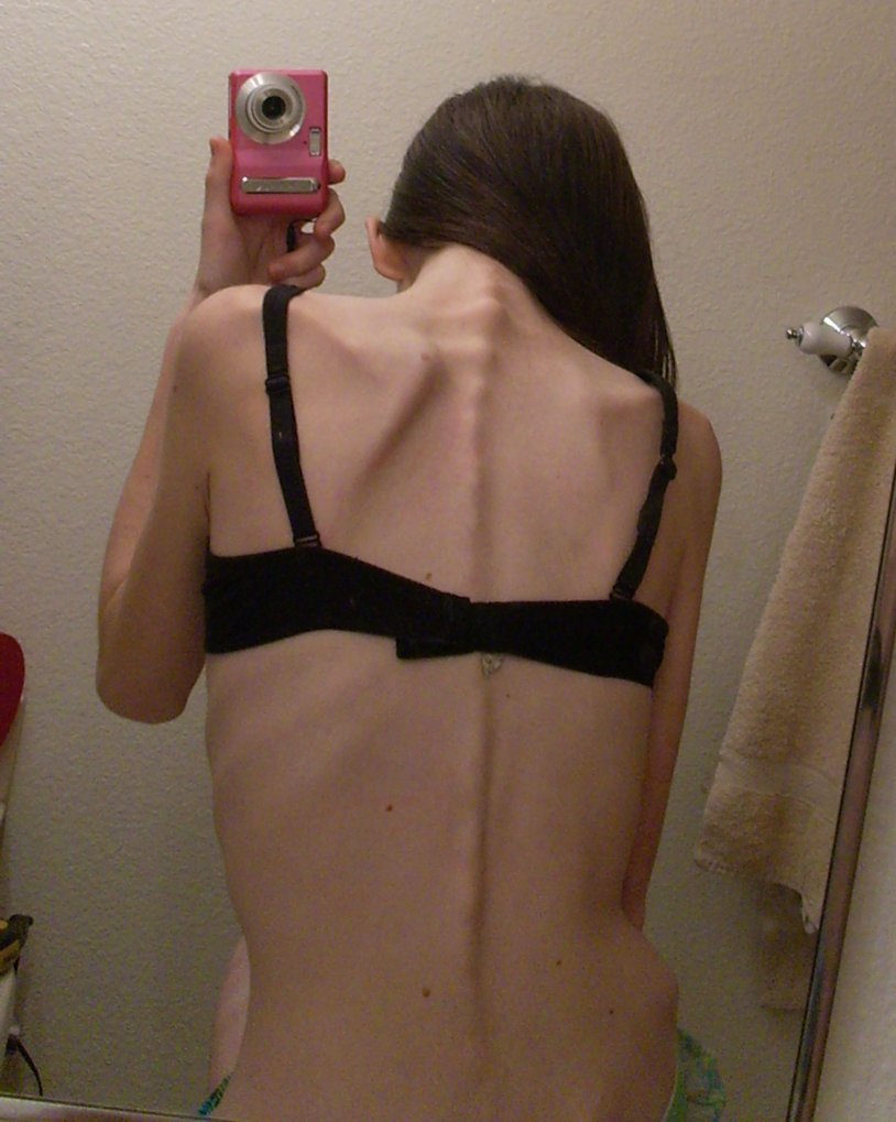 The spine of anorexics
