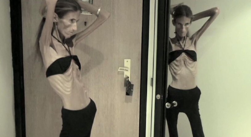 Lina Yegevskaya anorexia