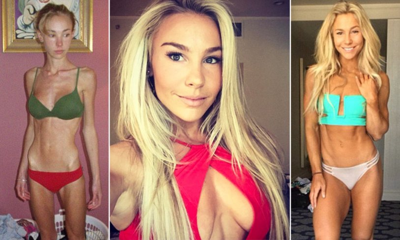 Fitness model of anorexia