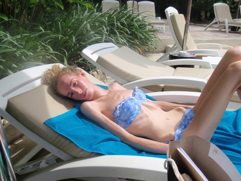 Girls anorexics in a swimsuit