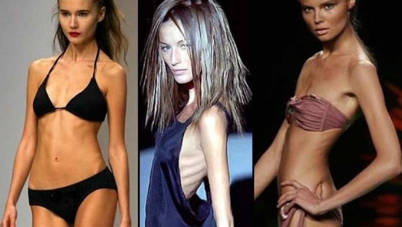 Anna Carolina Reston Anorexia