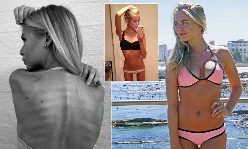 Dismorphomanic anorexia