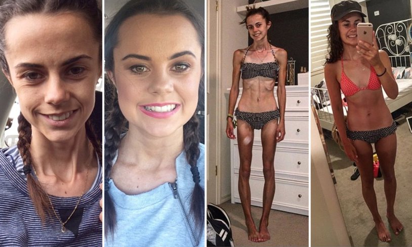 Anorexia before and after losing weight