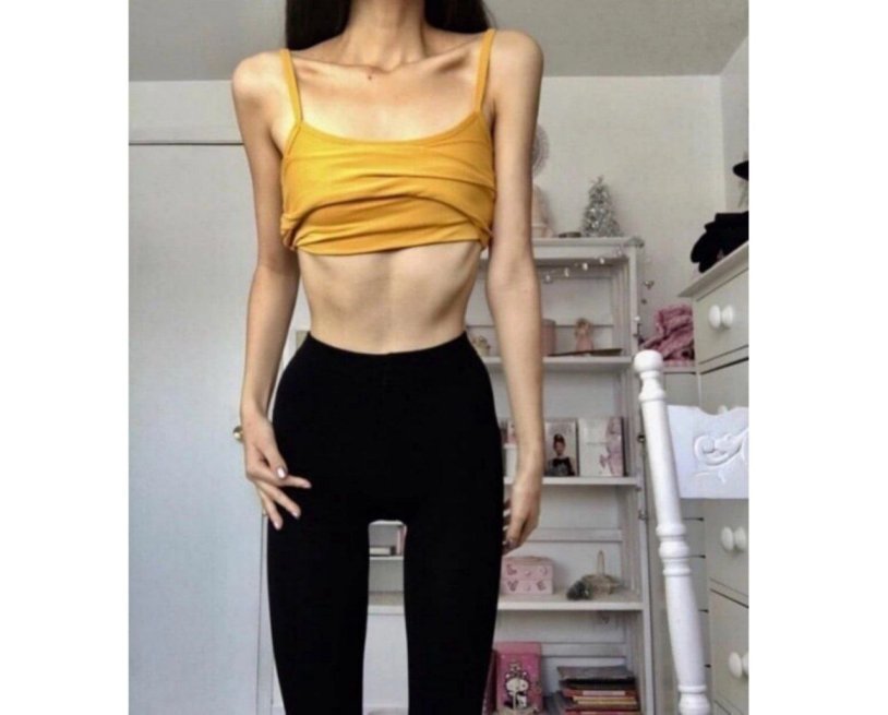 Beautiful anorexia