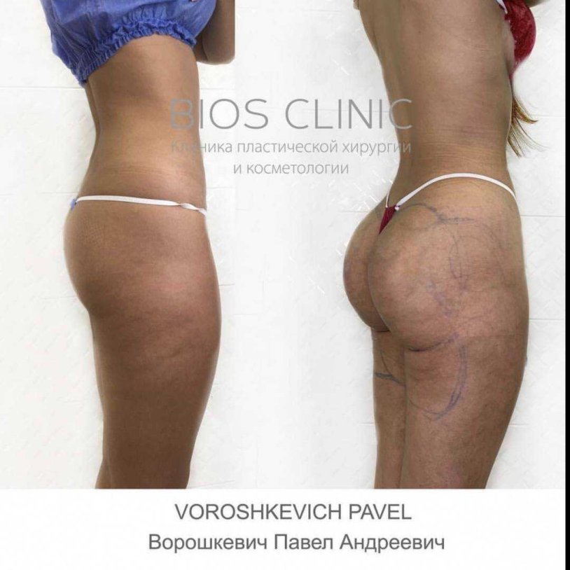 Lipofilling of the buttocks before and after