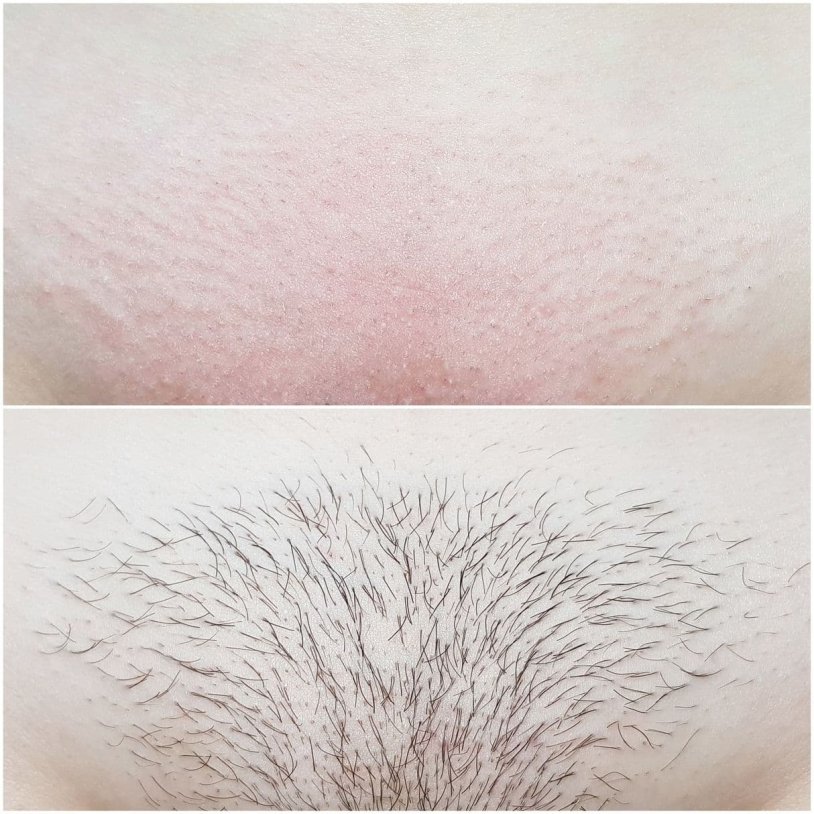 Activation of the deep bikini zone