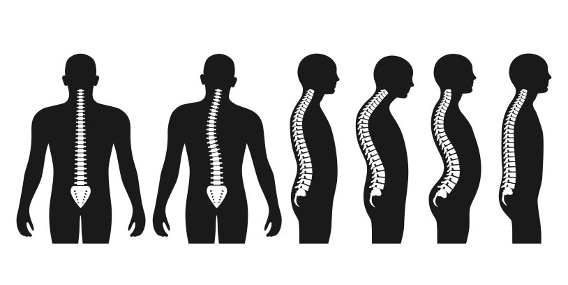 Lordosis kyphosis scoliosis