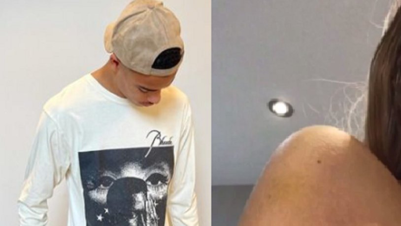 Harriet Robson photo bruises