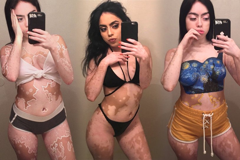 Ashley Soto Vitiligo Naked