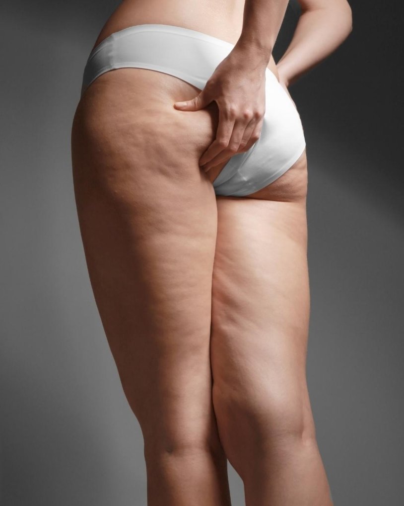 Cellulite on arms before after