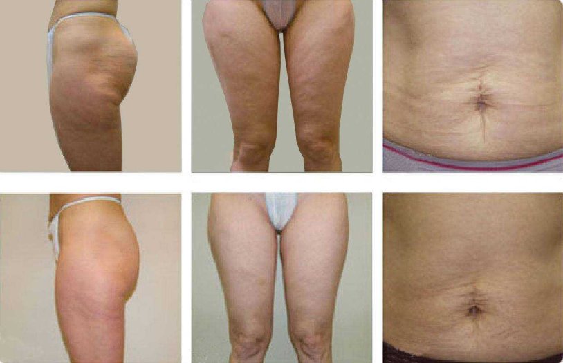 RF lipolysis of the abdomen