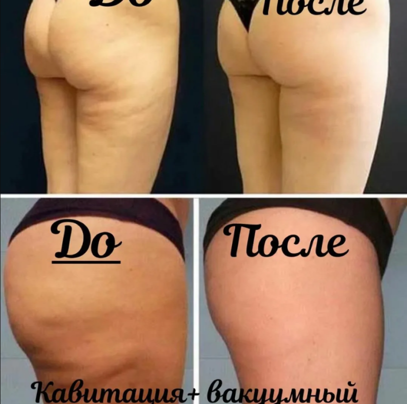 Cellulite before and after LPG massage