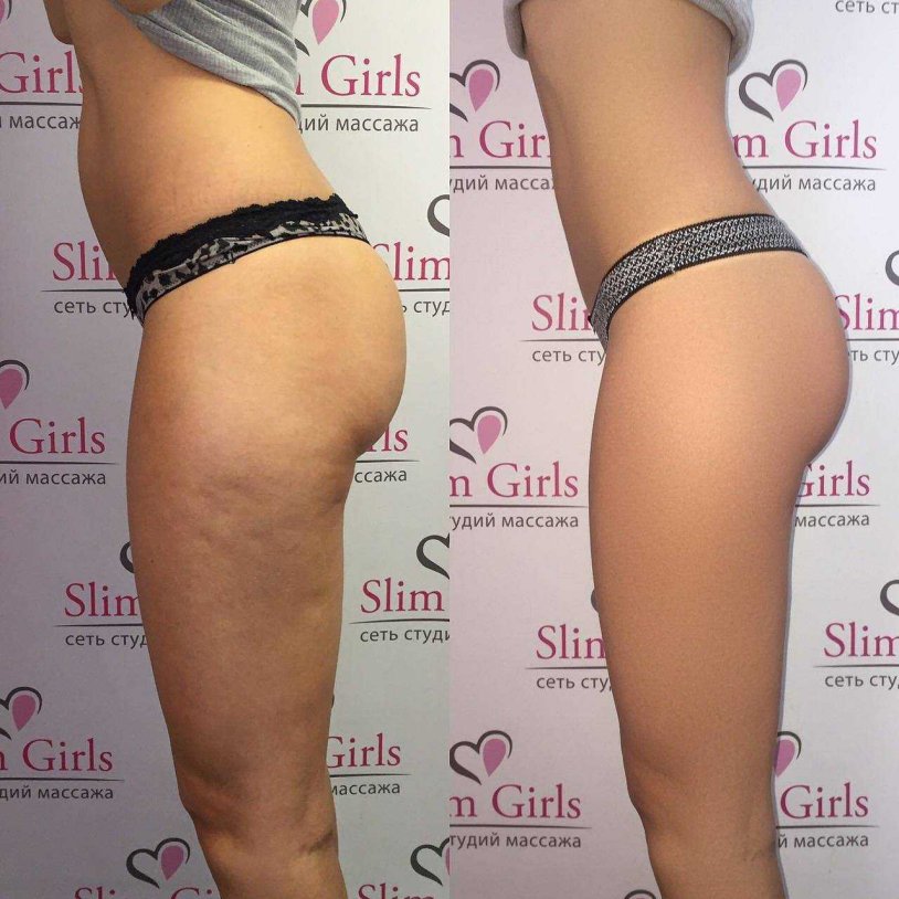 Anti-cellulite massage before and after