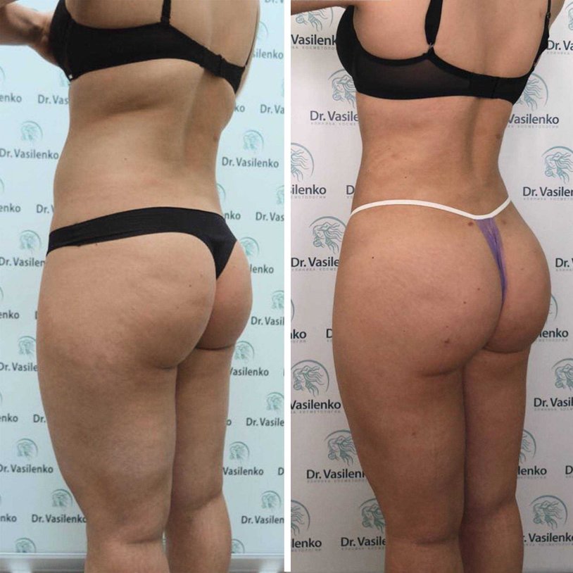 Lipofilling of the buttocks asymmetry