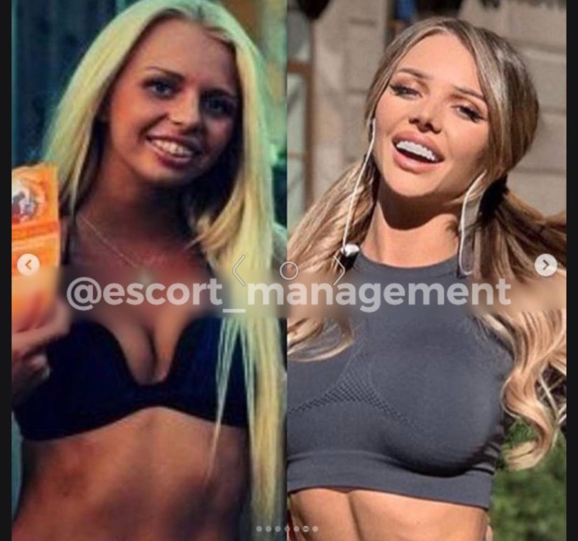 Lika Andreeva summerlovesummerl before plastic surgery